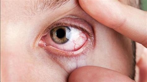 G­ö­z­ ­t­a­n­s­i­y­o­n­u­ ­k­ö­r­l­ü­ğ­e­ ­n­e­d­e­n­ ­o­l­a­b­i­l­i­r­ ­-­ ­S­a­ğ­l­ı­k­ ­H­a­b­e­r­l­e­r­i­